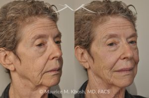 Photo of a patient before and after a procedure. Voluma Filler - before and after photo.