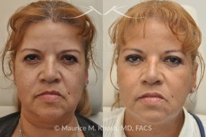 Photo of a patient before and after a procedure. Voluma Filler Injection and Botox Treatment by Dr. Maurice Khosh - before and after photo.