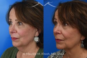 Photo of a patient before and after a procedure. Facelift for Natural Facial Rejuvenation and Lower Face Contouring - This is a 75 year-old who wanted to get rid of her neck waddle. She did not wish to have a full facelift operation as she was only concerned about the neck. A deep-plane neck lift was performed through a perfectly hidden incision under the chin. Excess fat was removed and the neck muscles were tightened. There are no incisions round the ears. The patient never took any pain medication. She is ecstatic with her results.