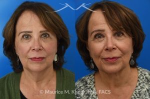 Photo of a patient before and after a procedure. Facelift for Natural Facial Rejuvenation and Lower Face Contouring - This is a 75 year-old who wanted to get rid of her neck waddle. She did not wish to have a full facelift operation as she was only concerned about the neck. A deep-plane neck lift was performed through a perfectly hidden incision under the chin. Excess fat was removed and the neck muscles were tightened. There are no incisions round the ears. The patient never took any pain medication. She is ecstatic with her results.
