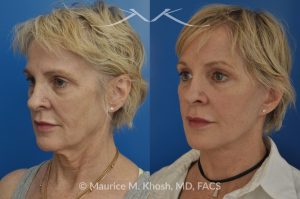 Photo of a patient before and after a procedure. SMAS Facelift with Neck and Temporal Brow Lift - 65 years old lady interested in improving her sagging neck, eliminating her jowls, and elevating the droopy eyebrow position. She underwent SMAS facelift, neck lift, and temporal brow lift.