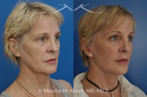 Photo of a patient before and after a procedure. SMAS Facelift with Neck and Temporal Brow Lift - 65 years old lady interested in improving her sagging neck, eliminating her jowls, and elevating the droopy eyebrow position. She underwent SMAS facelift, neck lift, and temporal brow lift.