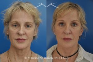 Photo of a patient before and after a procedure. SMAS Facelift with Neck and Temporal Brow Lift - 65 years old lady interested in improving her sagging neck, eliminating her jowls, and elevating the droopy eyebrow position. She underwent SMAS facelift, neck lift, and temporal brow lift.