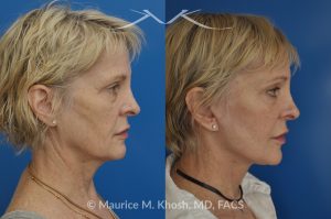 Photo of a patient before and after a procedure. SMAS Facelift with Neck and Temporal Brow Lift - 65 years old lady interested in improving her sagging neck, eliminating her jowls, and elevating the droopy eyebrow position. She underwent SMAS facelift, neck lift, and temporal brow lift.
