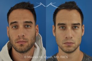 Photo of a patient before and after a procedure. Left-Sided Nasal Valve Repair with Spreader Graft - pre- and post-operative.
