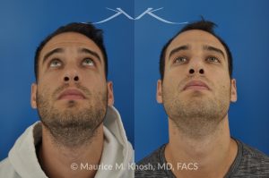 Photo of a patient before and after a procedure. Left-Sided Nasal Valve Repair with Spreader Graft - pre- and post-operative.