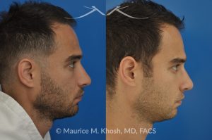 Photo of a patient before and after a procedure. Left-Sided Nasal Valve Repair with Spreader Graft - pre- and post-operative.