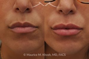 Photo of a patient before and after a procedure. Lip Augmentation with Hyaluronic Acid Filler - This 33-year-old young woman was interested in a beautiful and natural augmentation of her lips. She wanted more voluptuous and sexy lips without appearing puffy or over-done. Hyaluronic acid filler was used to give her a subtle but noticeable improvement.