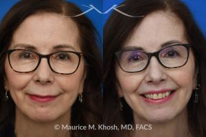 Photo of a patient before and after a procedure. Lip Lift - before and after lip lift procedure showing natural enhancement and improved shape of the lips.