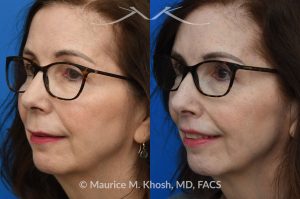 Photo of a patient before and after a procedure. Lip Lift - before and after lip lift procedure showing natural enhancement and improved shape of the lips.