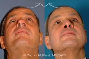 Photo of a patient before and after a procedure. Nasal Valve Repair with Septoplasty - pre- and post-operative.