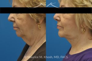 Photo of a patient before and after a procedure. Neck Lift for Skin Laxity and Turkey Wattles - This 70 year old lady with extensive laxity of skin in the central neck with droopy appearing neck and 'turkey wattles'. She was interested in achieving a younger, natural appearance to her neck.