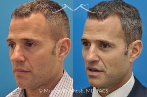 Photo of a patient before and after a procedure. Rhinoplasty for Twisted Nose - pre- and post-operative.