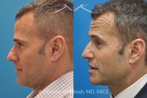 Photo of a patient before and after a procedure. Rhinoplasty for Twisted Nose - pre- and post-operative.