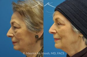 Photo of a patient before and after a procedure. Upper and Lower Blepharoplasty - 66 year old lady with troublesome puffiness of the lower eyelids and saggy upper eyelids. She was successfully treated with upper blepharoplasty and trans-conjunctival (through the inside of eyelid) lower blepharoplasty. Notice the substantial rejuvenated appearance of the entire face resulting from her eyelid lift procedure.