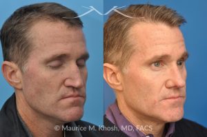 Photo of a patient before and after a procedure. Nasal Valve Repair with Rib Cartilage Graft - pre- and post-operative.