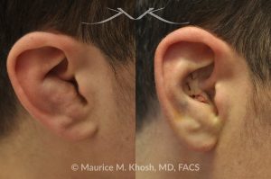 Photo of a patient before and after a procedure. Ear Hematoma (Blood Clot) Drainage - before-and-after composite photo.