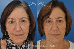 Photo of a patient before and after a procedure. Osteoma Removal from Forehead Under Local Anesthesia - 68 year old lady interested in osteoma removal in Manhattan. Problem: Hard, round, raised mass underneath the forehead skin. Procedure: Osteoma removal as an office procedure, under local anesthesia.