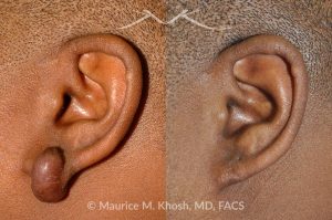 Photo of a patient before and after a procedure. Keloid Earlobe - before and after treatment results.