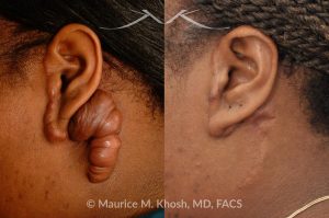 Photo of a patient before and after a procedure. Keloid Ear - before and after treatment results.