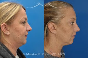 Photo of a patient before and after a procedure. Kybella treatment for double chin and neck fat - A 52 year old looking for non surgical treatment of her excess neck fat and double chin. She did not wish to have neck liposuction and preferred Kybella injections in New York City to dissolve the neck fat.