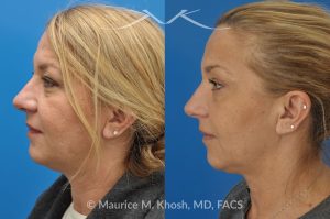 Photo of a patient before and after a procedure. Kybella treatment for double chin and neck fat - A 52 year old looking for non surgical treatment of her excess neck fat and double chin. She did not wish to have neck liposuction and preferred Kybella injections in New York City to dissolve the neck fat.
