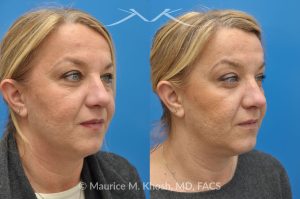 Photo of a patient before and after a procedure. Kybella treatment for double chin and neck fat - A 52 year old looking for non surgical treatment of her excess neck fat and double chin. She did not wish to have neck liposuction and preferred Kybella injections in New York City to dissolve the neck fat.
