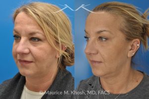 Photo of a patient before and after a procedure. Kybella treatment for double chin and neck fat - A 52 year old looking for non surgical treatment of her excess neck fat and double chin. She did not wish to have neck liposuction and preferred Kybella injections in New York City to dissolve the neck fat.