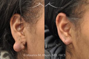Photo of a patient before and after a procedure. Large Keloid of Earlobe - before and after treatment results.