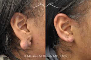 Photo of a patient before and after a procedure. Large Keloid of Earlobe - before and after treatment results.