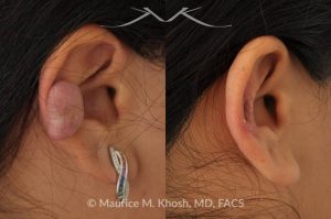 Photo of a patient before and after a procedure. Ear keloid - scar removal the middle front part of the ear.