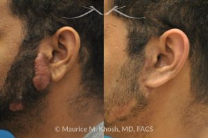 Photo of a patient before and after a procedure. Keloid - before and after treatment results.