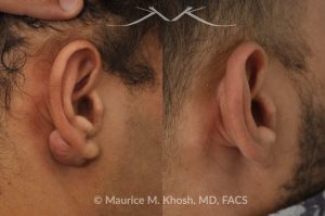 Photo of a patient before and after a procedure. Keloid-Free Earlobe Restoration - This 30 year old complained of developing a keloid scar on his earlobe following ear piercing. Keloid surgery in Manhattan office, followed by a series of injections resulted in complete restoration of the natural appearing earlobe.