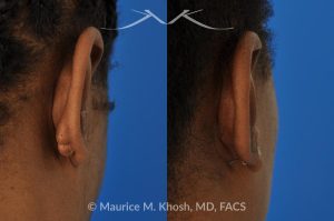 Photo of a patient before and after a procedure. Keloid of the Ear - before and after treatment results.