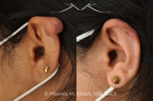 Photo of a patient before and after a procedure. Keloid After Ear Piercing - This delightful patient had formed a keloid after an ear piercing in the upper part of her ear. Keloid removal allowed restoration of a normal appearing ear. She is ecstatic with her results.
