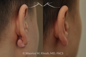 Photo of a patient before and after a procedure. Earlobe Keloid Removal (Posterior Side) - before and after treatment results.
