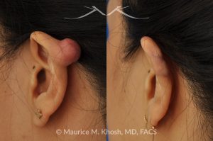 Photo of a patient before and after a procedure. Keloid scar removal from the upper part of the ear (auricle) - before and after treatment results.