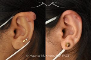 Photo of a patient before and after a procedure. Keloid After Ear Piercing - This delightful patient had formed a keloid after an ear piercing in the upper part of her ear. Keloid removal allowed restoration of a normal appearing ear. She is ecstatic with her results.
