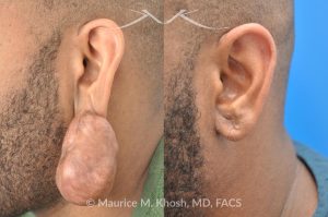Photo of a patient before and after a procedure. Large Keloid of Ear - before and after treatment results.