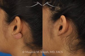 Photo of a patient before and after a procedure. Large Keloid - scar removed from the back of the ear.