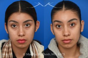 Photo of a patient before and after a procedure. Unilateral Otoplasty for Correction of Left Ear Deformity - This young patient had a left ear deformity with over-projection of the upper aspect of the ear due to poor formation of the helical fold of the ear. Unilateral otoplasty was performed in the office under local anesthesia. Mustarde suture technique was used to create a properly contoured helical fold. 