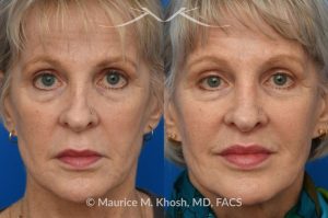 Photo of a patient before and after a procedure. Lip Lift - before and after photo showing enhanced shape and definition of the lips.