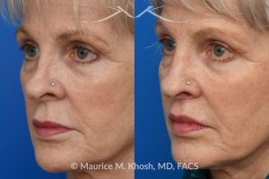 Photo of a patient before and after a procedure. Lip Lift - before and after photo showing enhanced shape and definition of the lips.