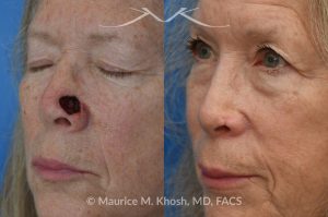 Photo of a patient before and after a procedure. Mohs repair of nose - Mohs excision of a basal cell carcinoma resulted in this large defect in the left lower nose. Initially a full thickness skin graft was used to resurface the nose. Following the skin graft, there was some contracture of the internal nose which compromised the patient's breathing. This problem was addressed with a composite (skin and cartilage graft) from the ear to inside of the nose. 