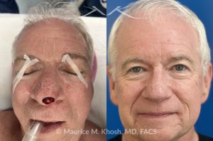 Photo of a patient before and after a procedure. Nasal tip reconstruction after Mohs cancer excision - This lovely patient underwent Mohs excision of basal cell carcinoma of the nasal tip. The defect was repaired with a local flap of nasal skin. The surgery actually helped to improve the nasal appearance by slightly elevating the tip. 
