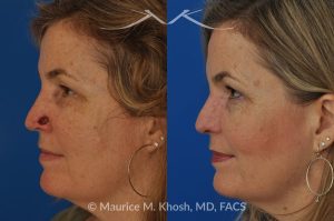 Photo of a patient before and after a procedure. Moh's repair of nose defect after removal of skin cancer. A bilobed flap was used for the repair - before and after photos.