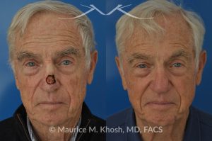 Photo of a patient before and after a procedure. Mohs repair of nose skin cancer with forehead flap - before and after photos.