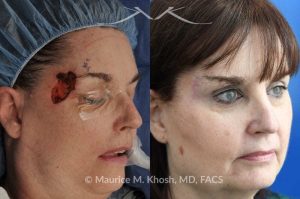 Photo of a patient before and after a procedure. Mohs Defect Repair of the Right Temple and Forehead - This delightful patient was referred for repair of a Moh's defect following excision of a basal cell cancer from the right temple and forehead. Repair was accomplished with a flap repair. The post op results demonstrate her at 6 months following repair. 