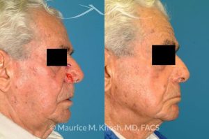 Photo of a patient before and after a procedure. Nose alar Moh's skin cancer reconstruction - before and after photos.