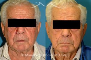 Photo of a patient before and after a procedure. Nose alar Moh's skin cancer reconstruction - before and after photos.